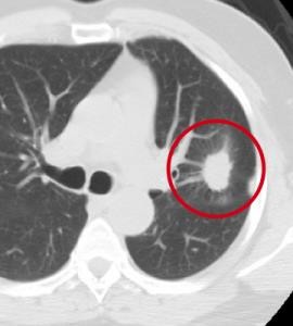 CT screening for lung cancer -2